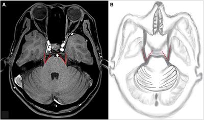 Risk Factors for Unilateral Trigeminal Neuralgia Based on Machine Learning